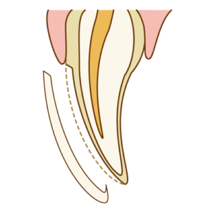 インビザライン ラミネートベニア