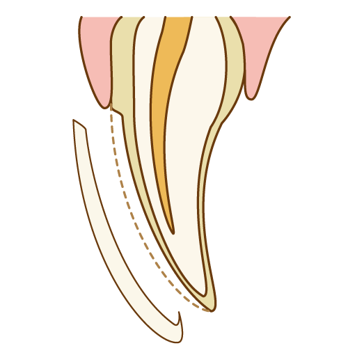 インビザライン　ラミネートベニア