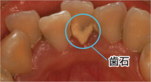インビザライン 歯石