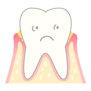 インビザライン プラーク