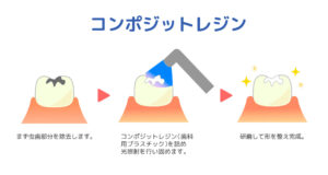 インビザライン 白い詰め物