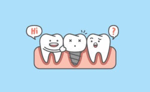 インビザライン インプラント