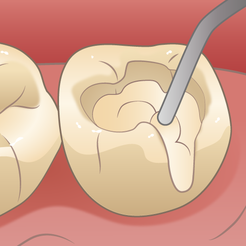 インビザライン 白い詰め物
