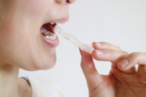 インビザライン 違和感