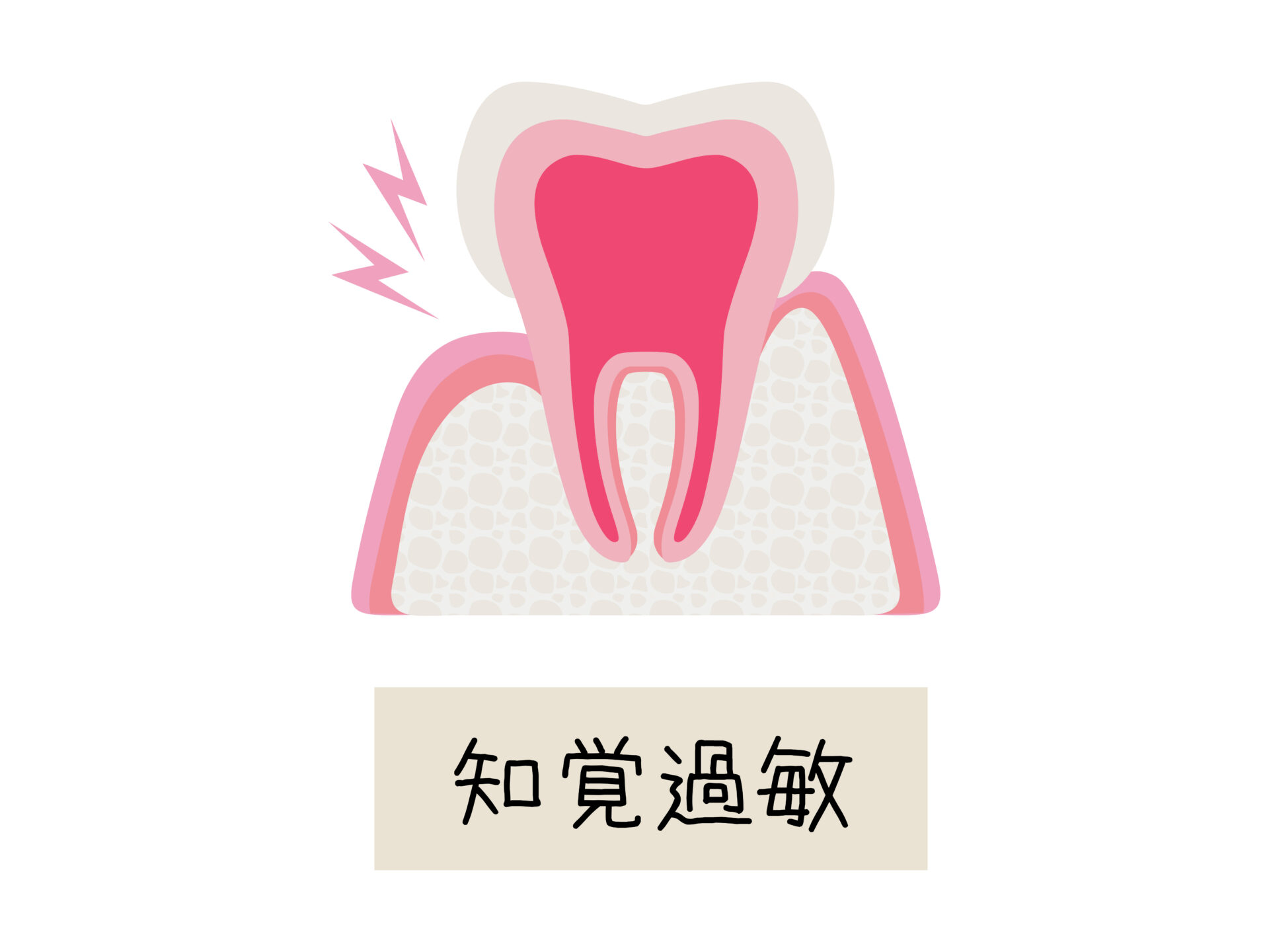 インビザライン 知覚過敏