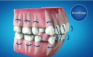 インビザライン 突起物
