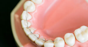 インビザライン リテーナー