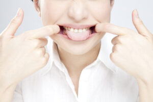 インビザライン 口腔習癖