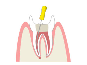インビザライン　神経とった