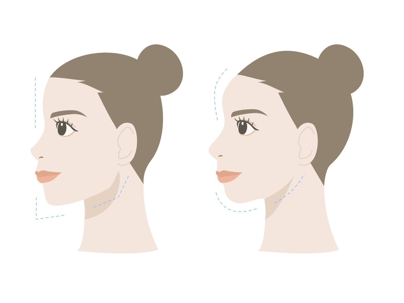 インビザライン エラ張り