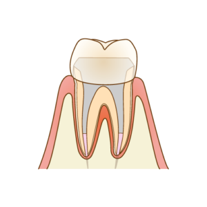 インビザライン　神経とった