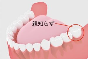 インビザライン 親知らず