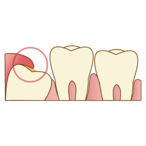 インビザライン 親知らず