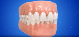 インビザライン バイトランプ