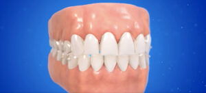 インビザライン バイトランプ