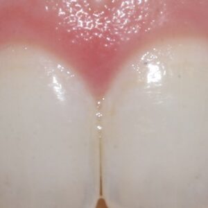 インビザライン 歯ぐきから出血