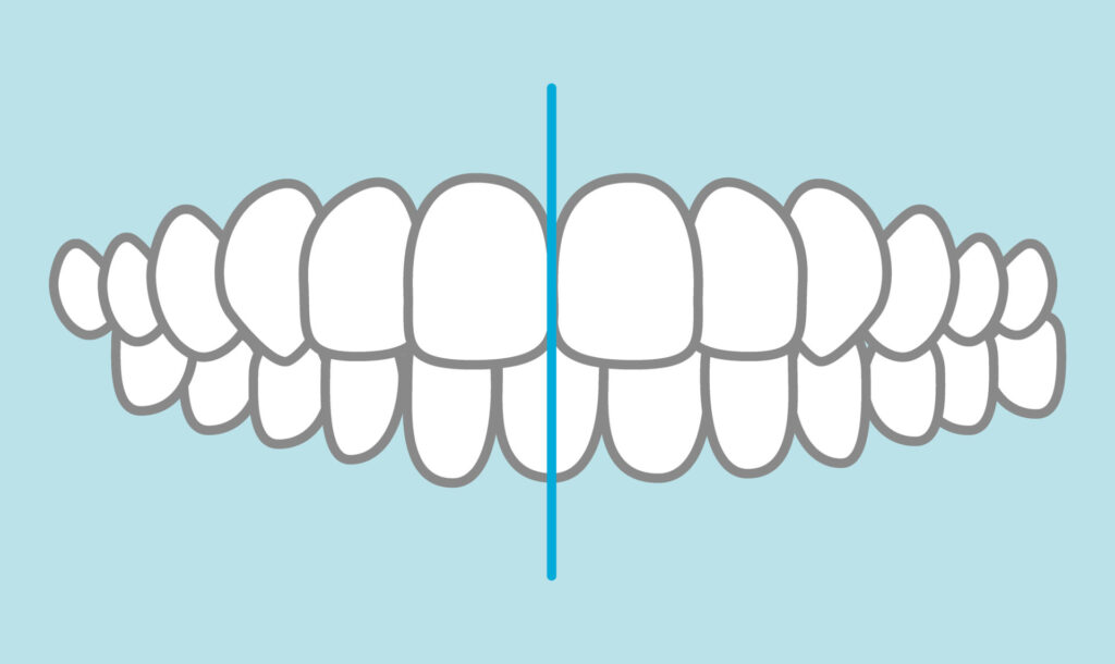 インビザライン　正中