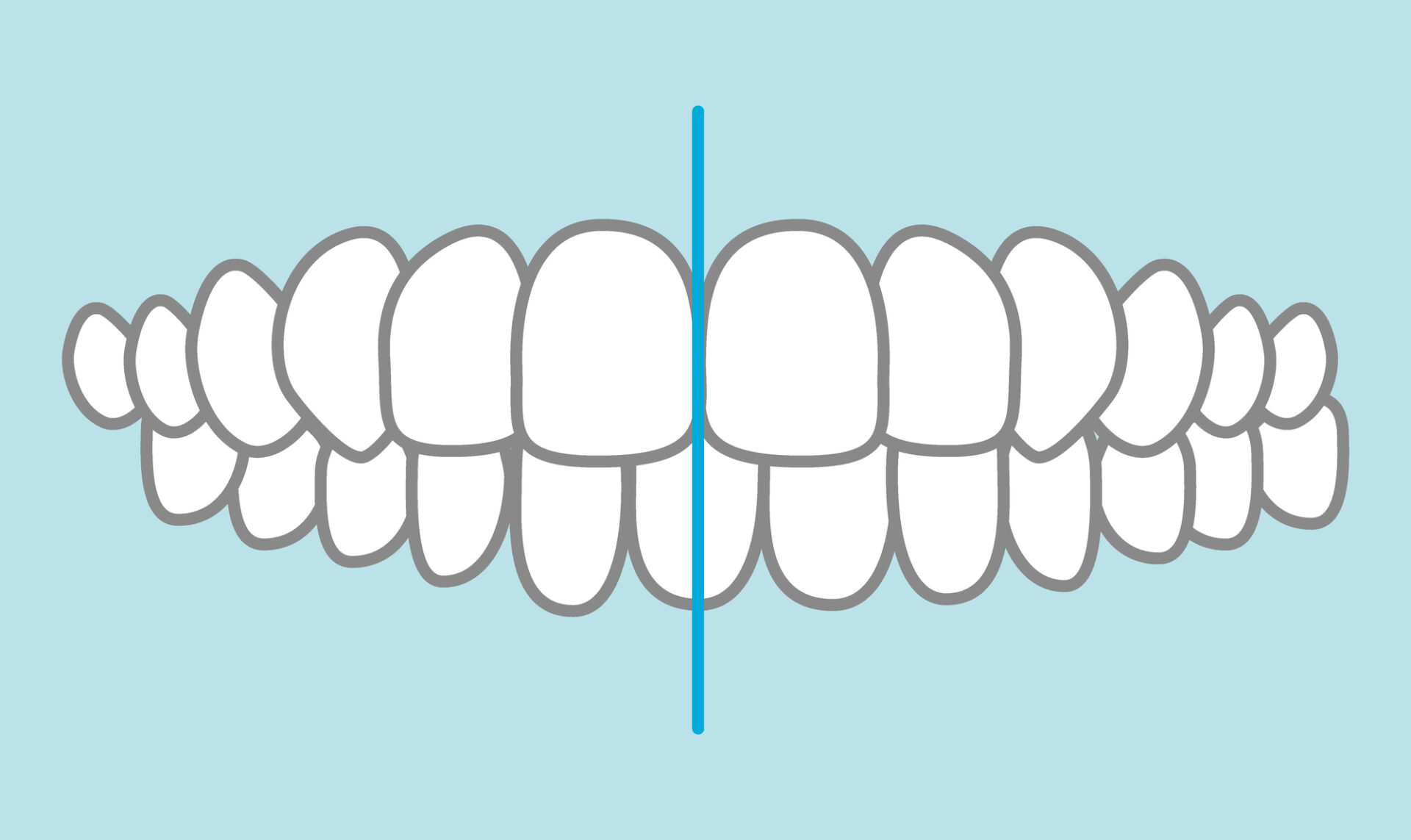 インビザライン　正中