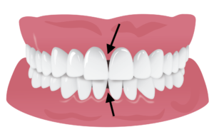 インビザライン ブラックトライアングル