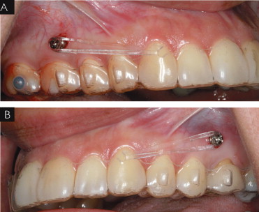 インビザライン　アンカースクリュー