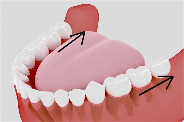 インビザライン　遠心移動