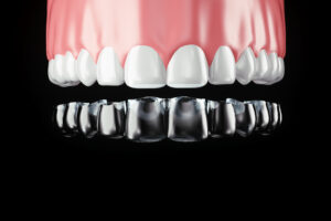 インビザライン　遠心移動