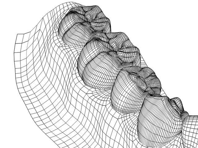 インビザライン　奥歯
