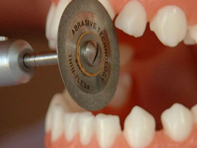 インビザライン IPR