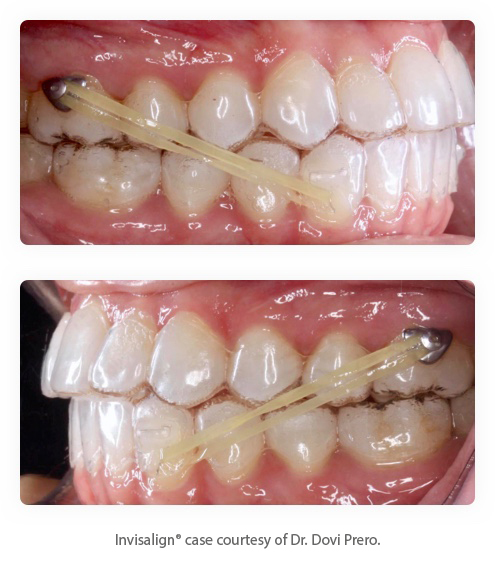 インビザライン リンガルボタン