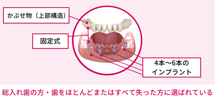 オールオン4・オールオン6