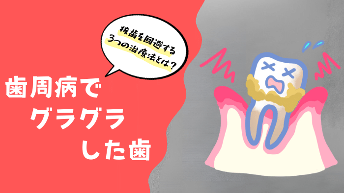 歯周病でグラグラした歯は自然治癒しない！抜歯を回避する3つの治療法