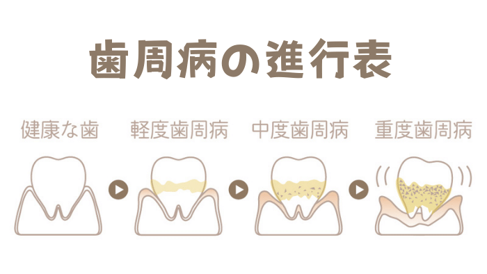 重症化した歯周病とは？
