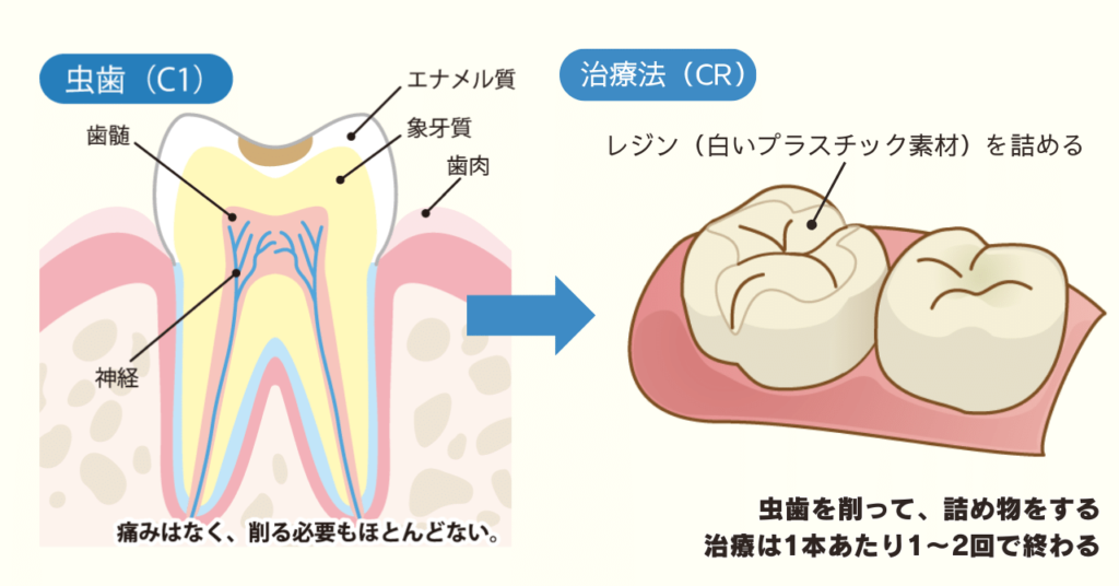 【C1】軽度の場合