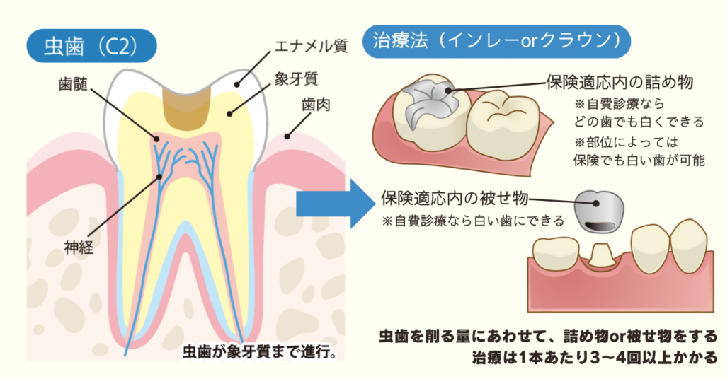 【C2】中度の場合