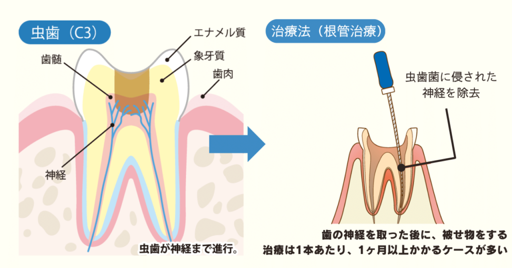 【C3】重度の場合