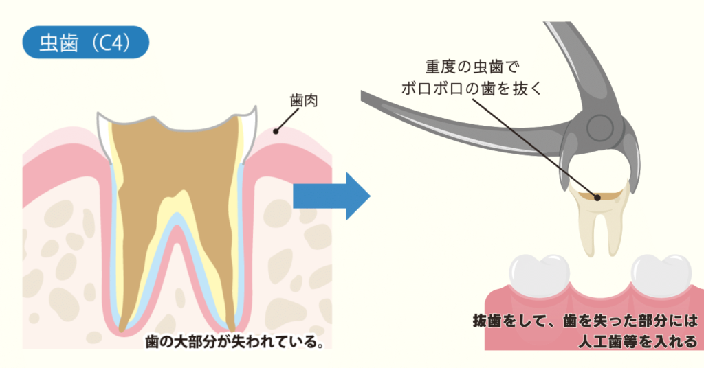 【C4】最重度の場合