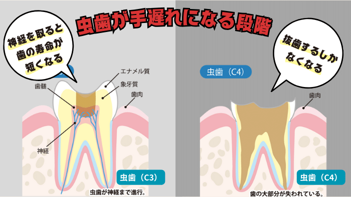 歯科医師が虫歯が手遅れだと感じる段階は？