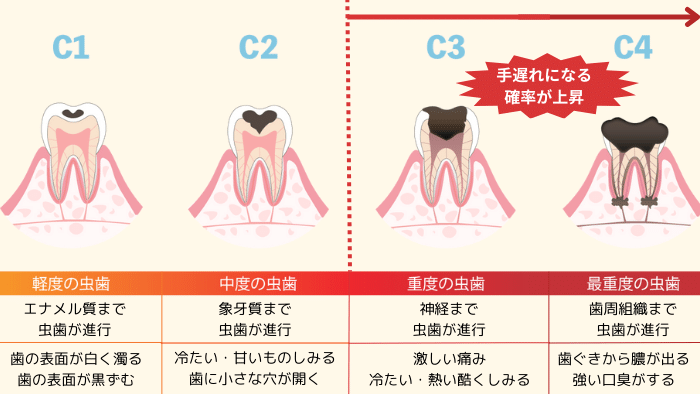 【進行度別】虫歯が手遅れになる症状は？