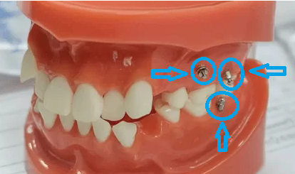 アンカースクリュー矯正